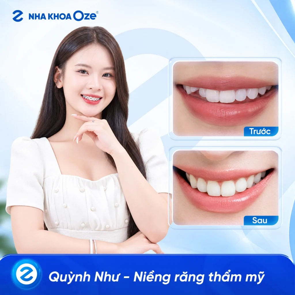 Feedback Niềng Răng 4