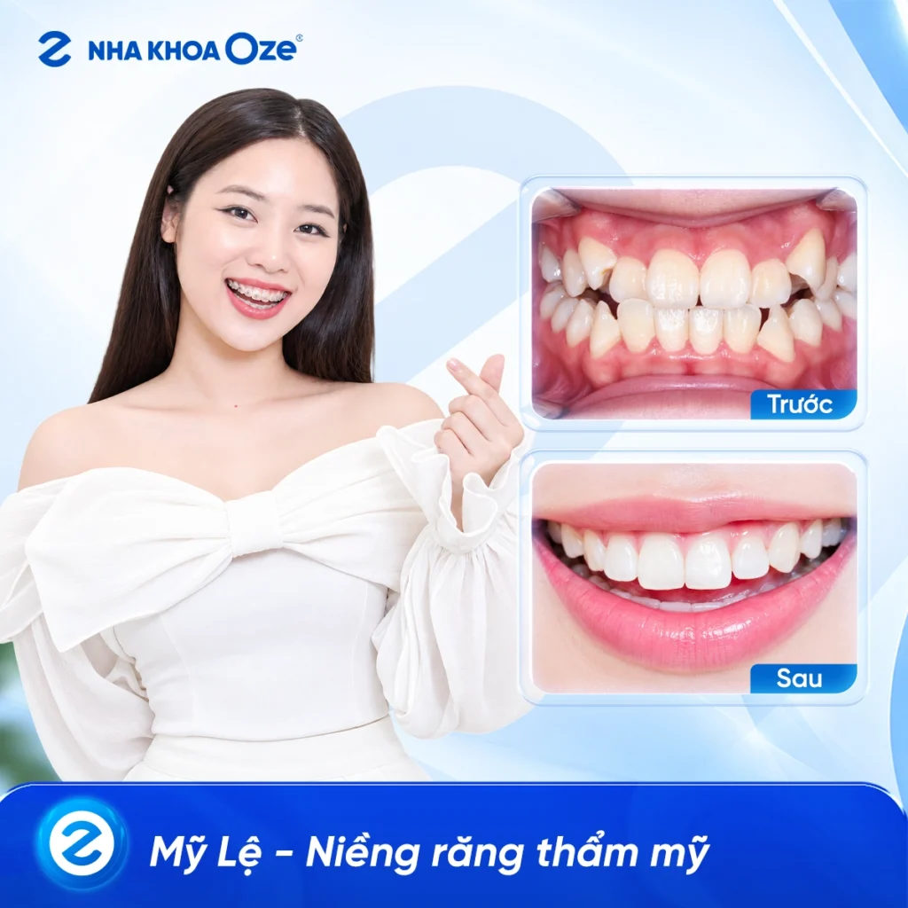 Feedback Niềng Răng 5