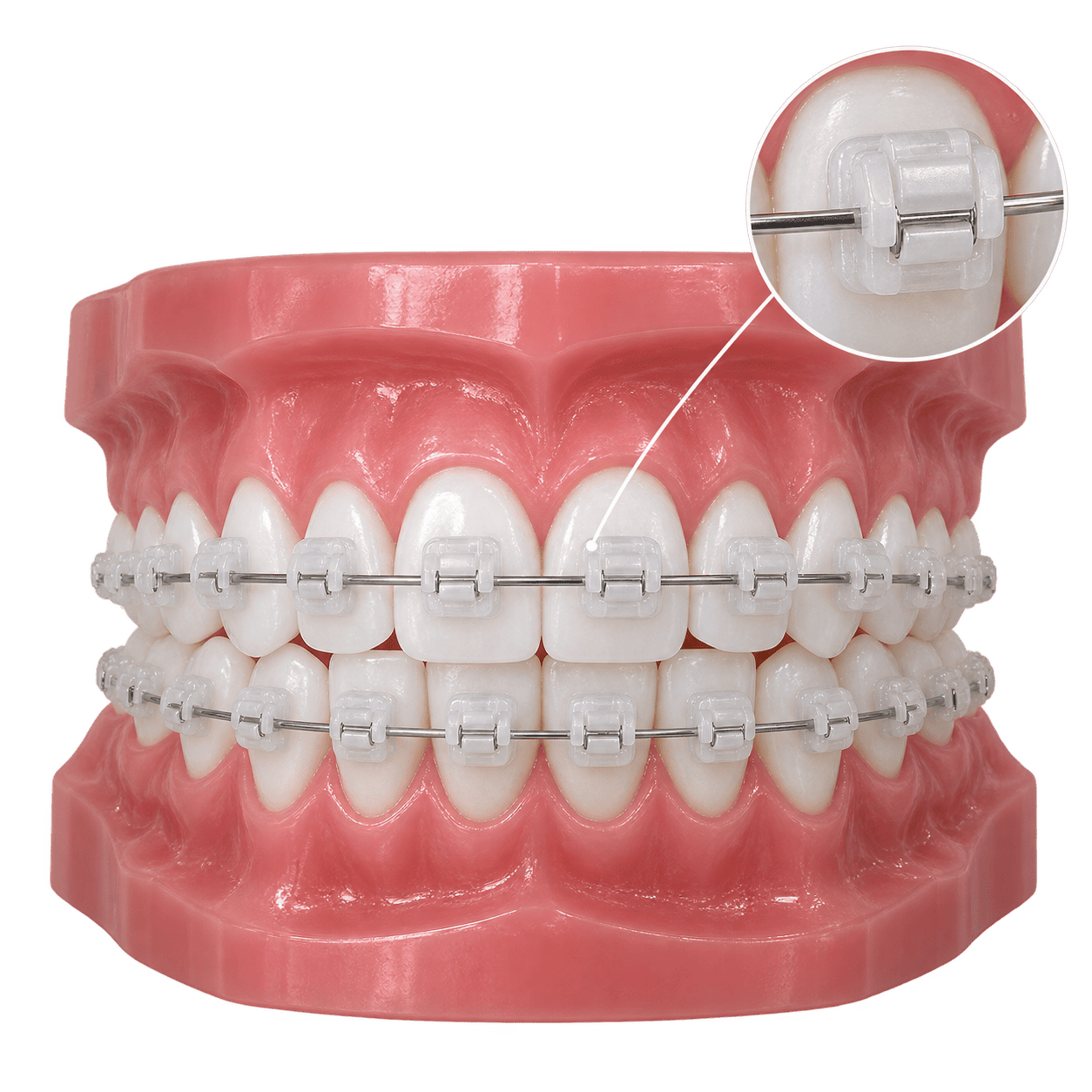 Niềng răng mắc cài sứ tự buộc