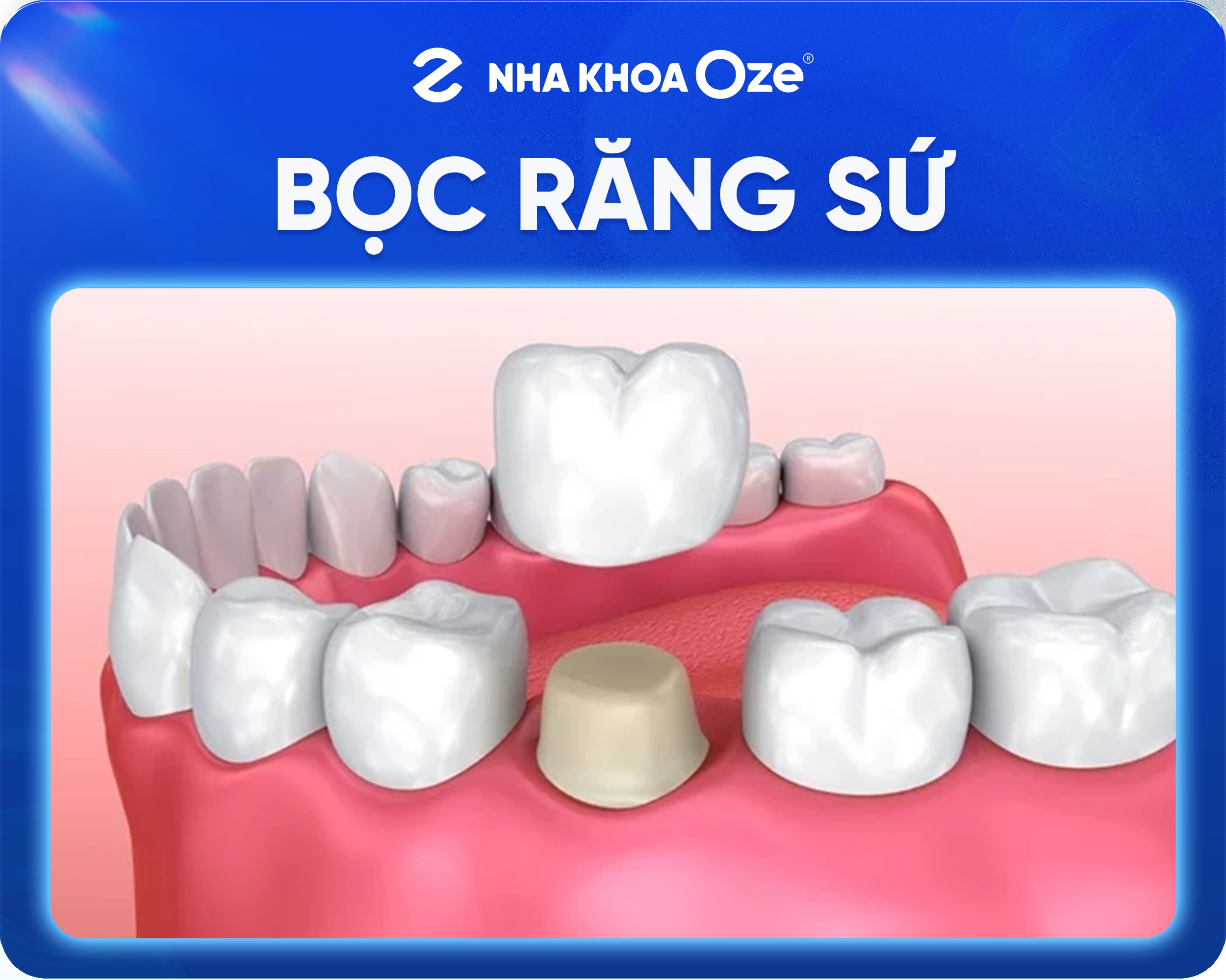 Bọc răng sứ