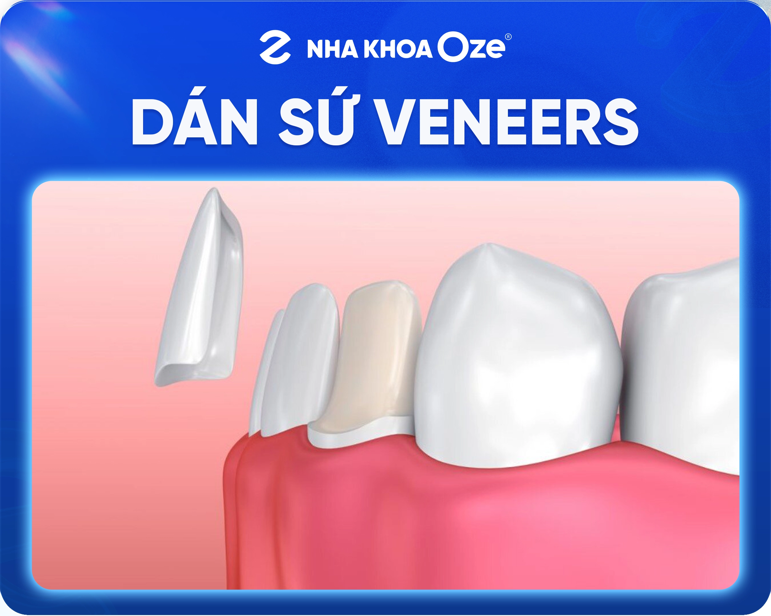 Dán sứ Veneer