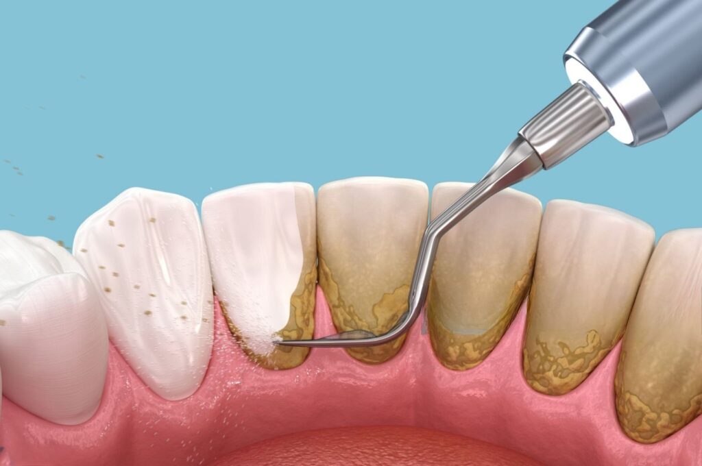 Lấy Cao Răng Đau Không? Ê Buốt, Chảy Máu Sau Khi Lấy Và Cách Xử Lý