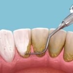 Lấy Cao Răng Đau Không? Ê Buốt, Chảy Máu Sau Khi Lấy Và Cách Xử Lý