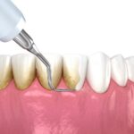 Lấy cao răng: Quy trình, chi phí và những điều cần biết
