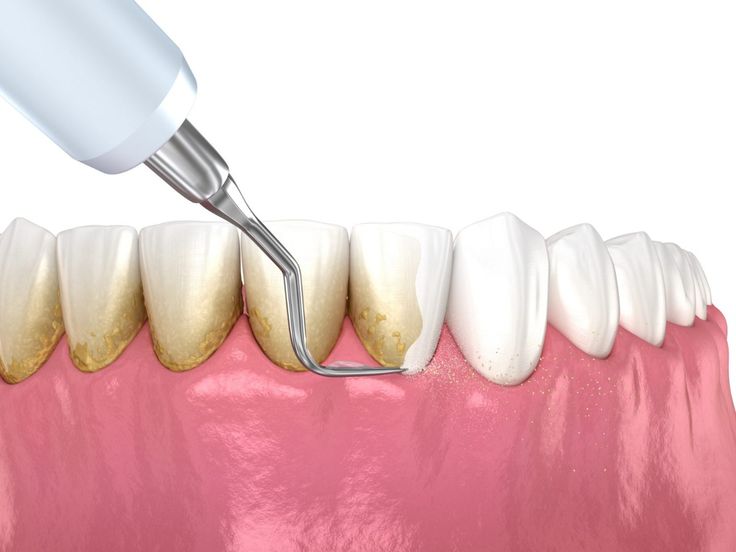 Lấy cao răng: Quy trình, chi phí và những điều cần biết
